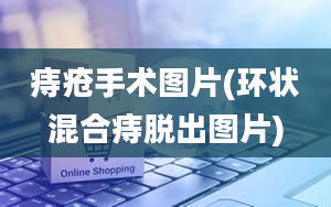 痔疮手术图片(环状混合痔脱出图片)